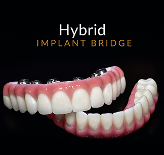 Hybrid Implant Bridge