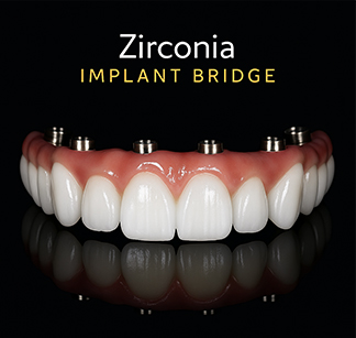 Zirconia Implant Bridge