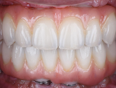 AGGRESSIVE BONE REDUCTION